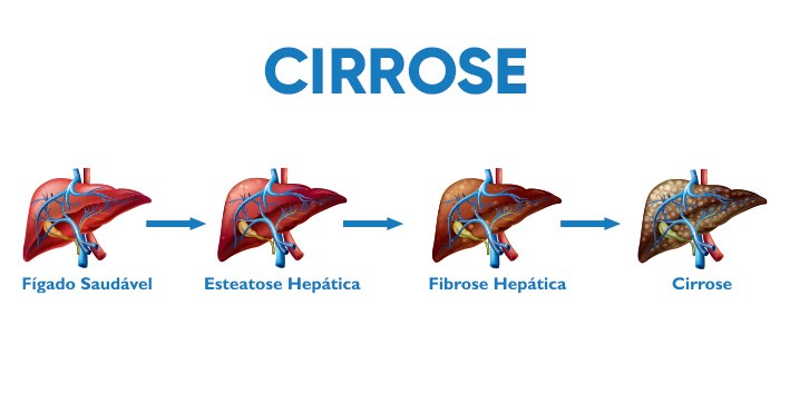 Hepatite e cirrose alcoolica